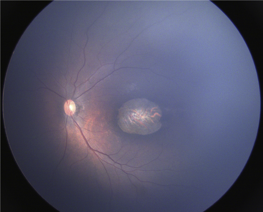 Wide-angle fundus image (RetCam) of the left eye of a child with congenital Zika syndrome showing large chorioretinal scar in the macular region.